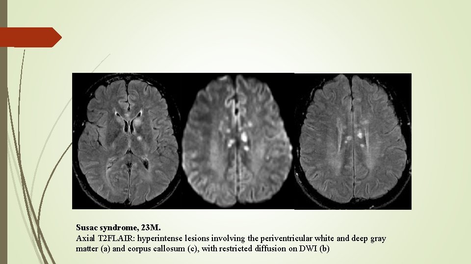 Susac syndrome, 23 M. Axial T 2 FLAIR: hyperintense lesions involving the periventricular white