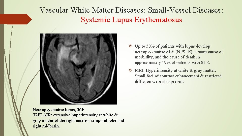 Vascular White Matter Diseases: Small-Vessel Diseases: Systemic Lupus Erythematosus Up to 50% of patients