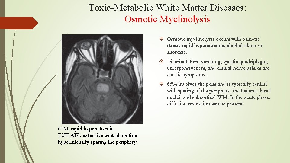 Toxic-Metabolic White Matter Diseases: Osmotic Myelinolysis Osmotic myelinolysis occurs with osmotic stress, rapid hyponatremia,