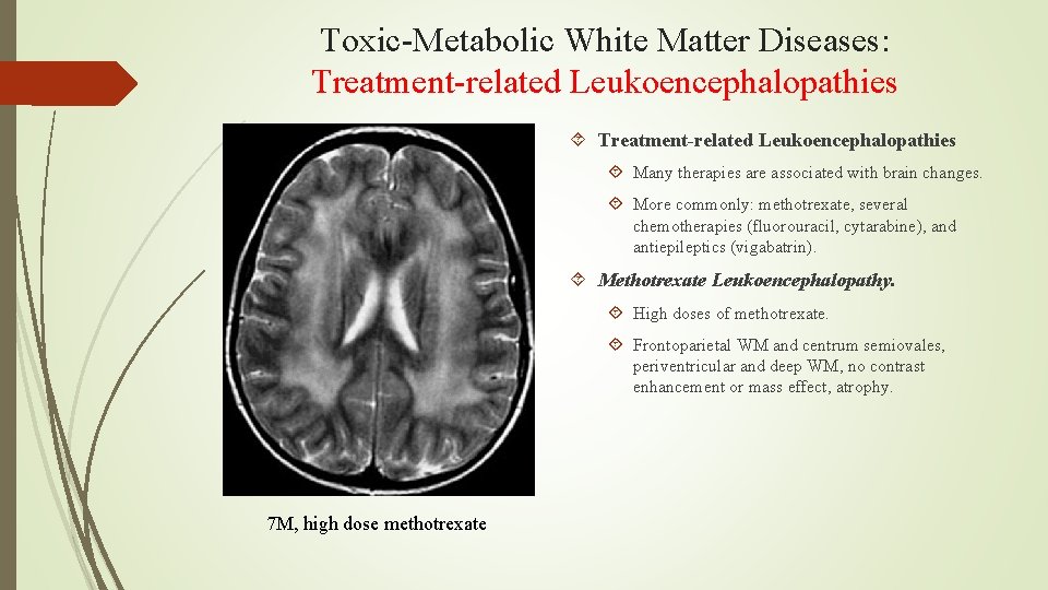Toxic-Metabolic White Matter Diseases: Treatment-related Leukoencephalopathies Many therapies are associated with brain changes. More