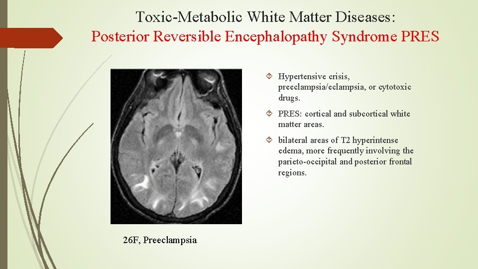 Toxic-Metabolic White Matter Diseases: Posterior Reversible Encephalopathy Syndrome PRES Hypertensive crisis, preeclampsia/eclampsia, or cytotoxic