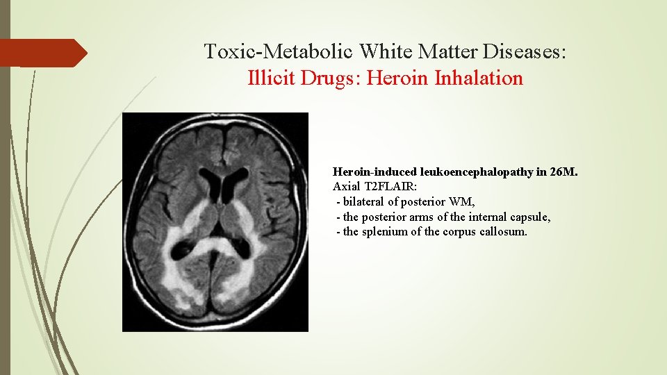 Toxic-Metabolic White Matter Diseases: Illicit Drugs: Heroin Inhalation Heroin-induced leukoencephalopathy in 26 M. Axial