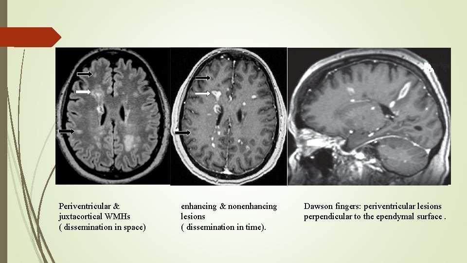 Periventricular & juxtacortical WMHs ( dissemination in space) enhancing & nonenhancing lesions ( dissemination