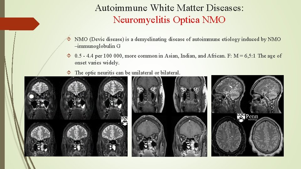 Autoimmune White Matter Diseases: Neuromyelitis Optica NMO (Devic disease) is a demyelinating disease of