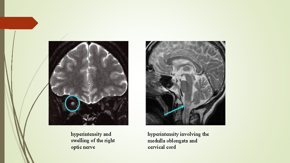 hyperintensity and swelling of the right optic nerve hyperintensity involving the medulla oblongata and