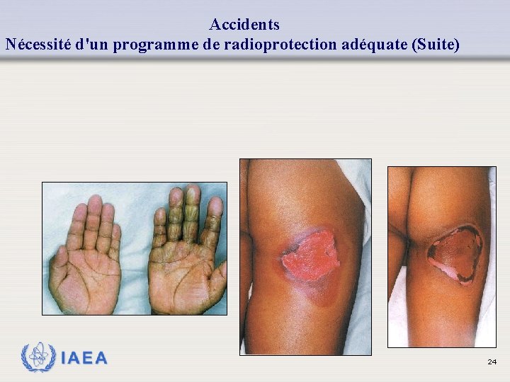 Accidents Nécessité d'un programme de radioprotection adéquate (Suite) IAEA 24 