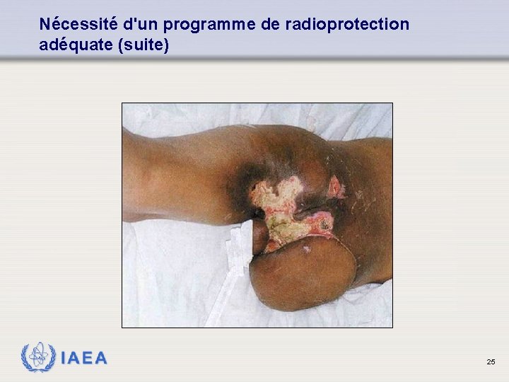 Nécessité d'un programme de radioprotection adéquate (suite) IAEA 25 