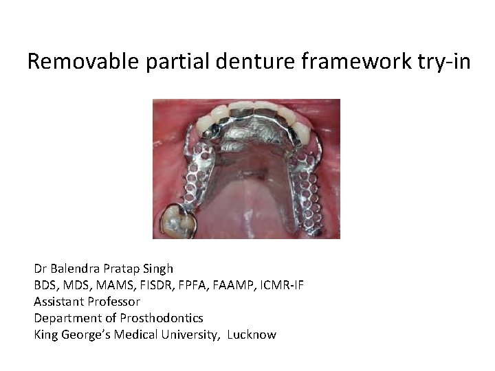 Removable partial denture framework try-in Dr Balendra Pratap Singh BDS, MAMS, FISDR, FPFA, FAAMP,