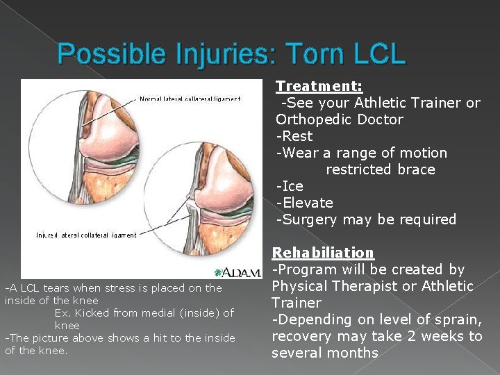 Possible Injuries: Torn LCL Treatment: -See your Athletic Trainer or Orthopedic Doctor -Rest -Wear