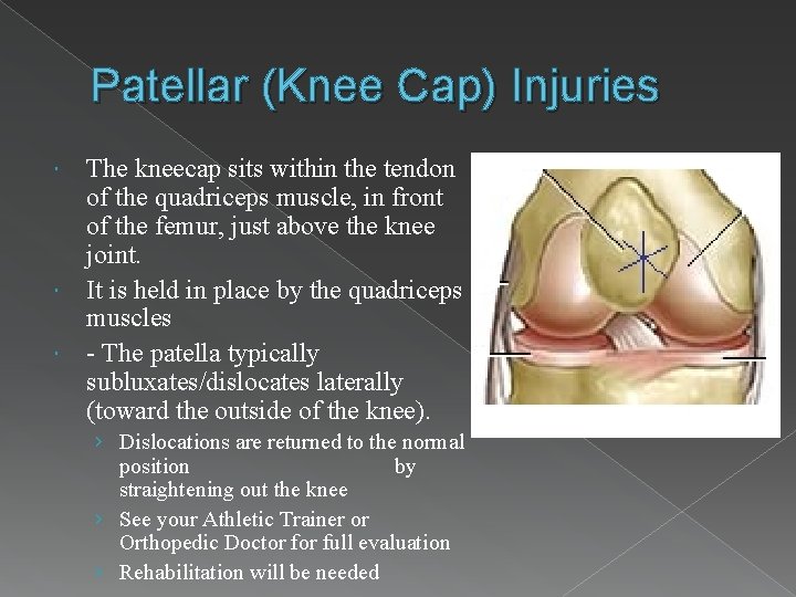 Patellar (Knee Cap) Injuries The kneecap sits within the tendon of the quadriceps muscle,