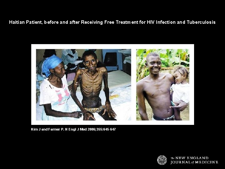 Haitian Patient, before and after Receiving Free Treatment for HIV Infection and Tuberculosis Kim