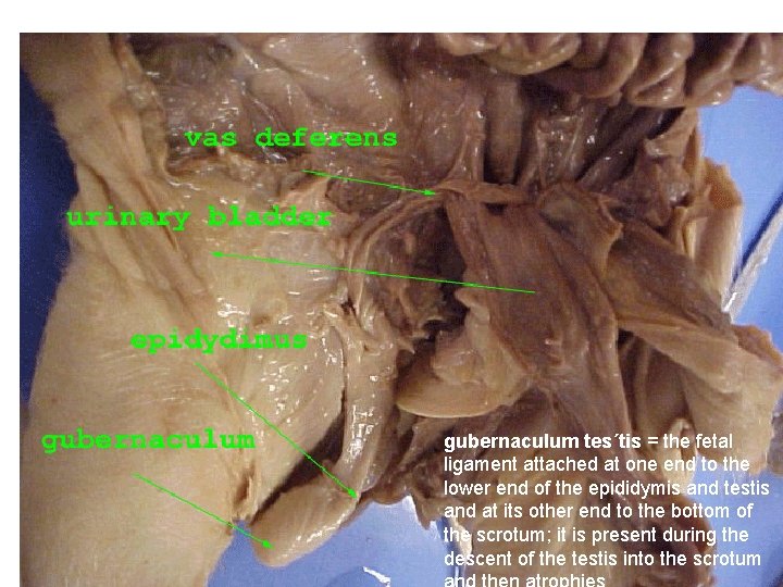 gubernaculum tes´tis = the fetal ligament attached at one end to the lower end