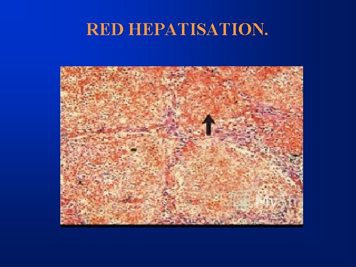 RED HEPATISATION. 