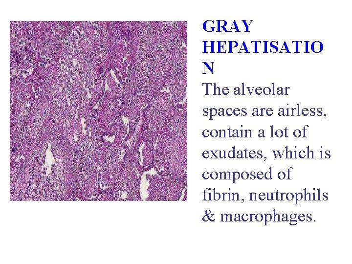 GRAY HEPATISATIO N The alveolar spaces are airless, contain a lot of exudates, which