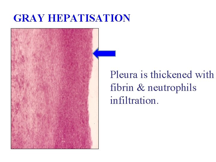 GRAY HEPATISATION Pleura is thickened with fibrin & neutrophils infiltration. 