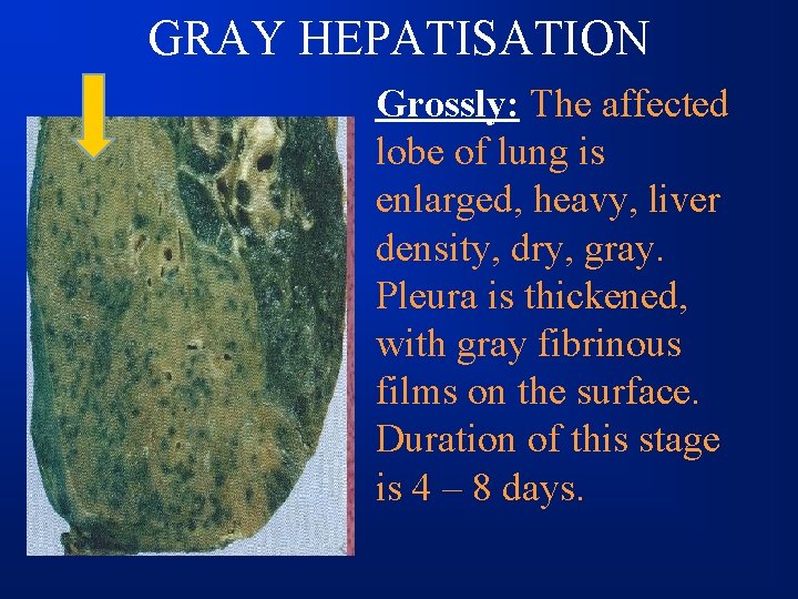 GRAY HEPATISATION Grossly: The affected lobe of lung is enlarged, heavy, liver density, dry,