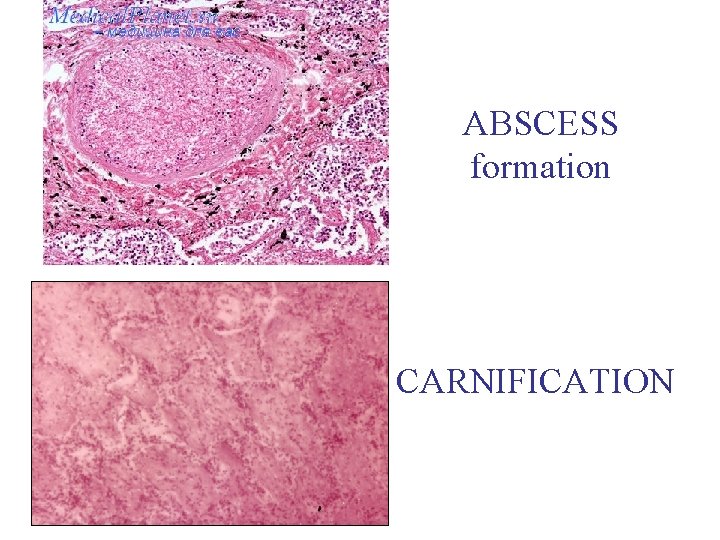 ABSCESS formation CARNIFICATION 