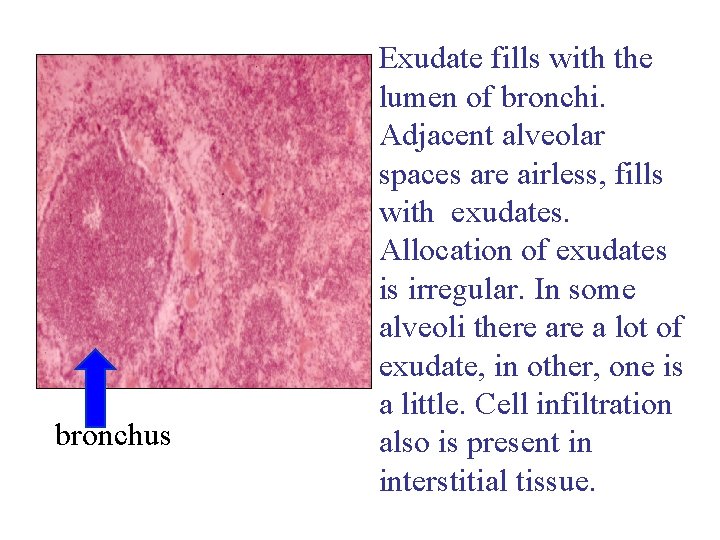 bronchus Exudate fills with the lumen of bronchi. Adjacent alveolar spaces are airless, fills