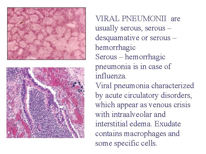 VIRAL PNEUMONII are usually serous, serous – desquamative or serous – hemorrhagic Serous –