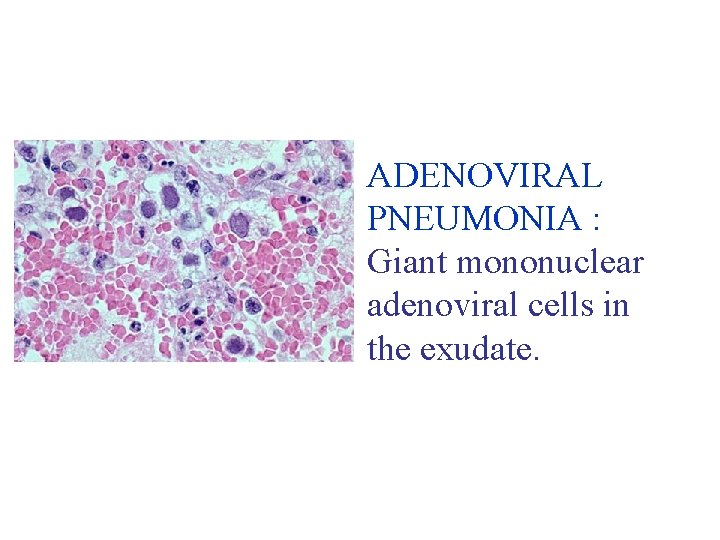 ADENOVIRAL PNEUMONIA : Giant mononuclear adenoviral cells in the exudate. 