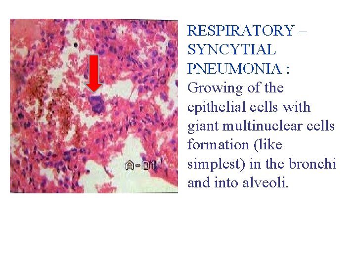 RESPIRATORY – SYNCYTIAL PNEUMONIA : Growing of the epithelial cells with giant multinuclear cells