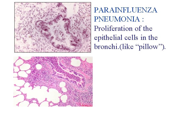 PARAINFLUENZA PNEUMONIA : Proliferation of the epithelial cells in the bronchi. (like “pillow”). 