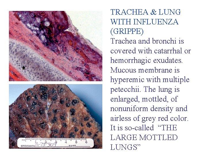 TRACHEA & LUNG WITH INFLUENZA (GRIPPE) Trachea and bronchi is covered with catarrhal or