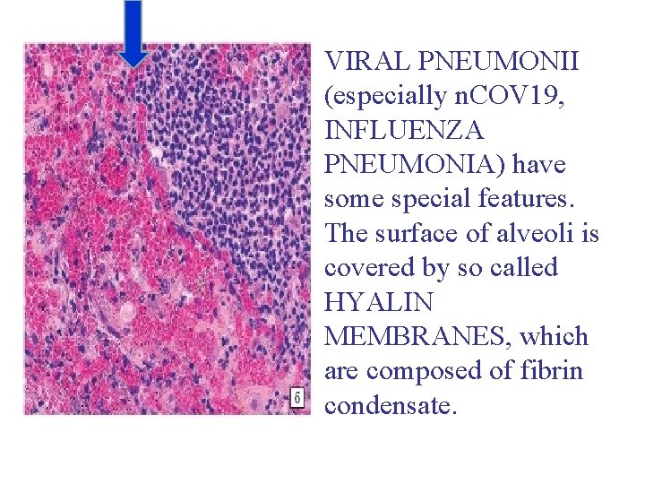 VIRAL PNEUMONII (especially n. COV 19, INFLUENZA PNEUMONIA) have some special features. The surface