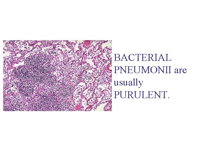 BACTERIAL PNEUMONII are usually PURULENT. 