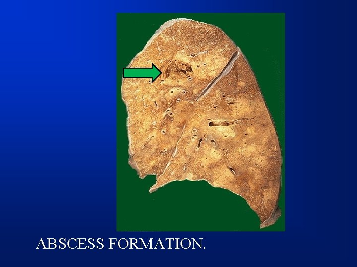 ABSCESS FORMATION. 