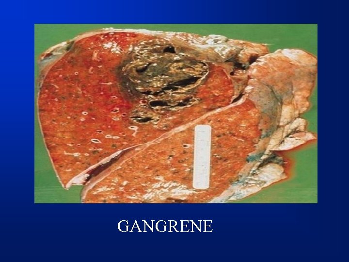 GANGRENE 