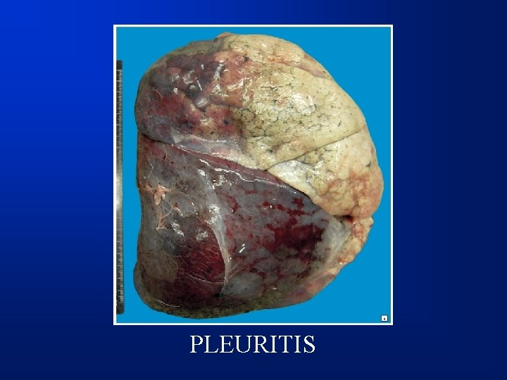 PLEURITIS 