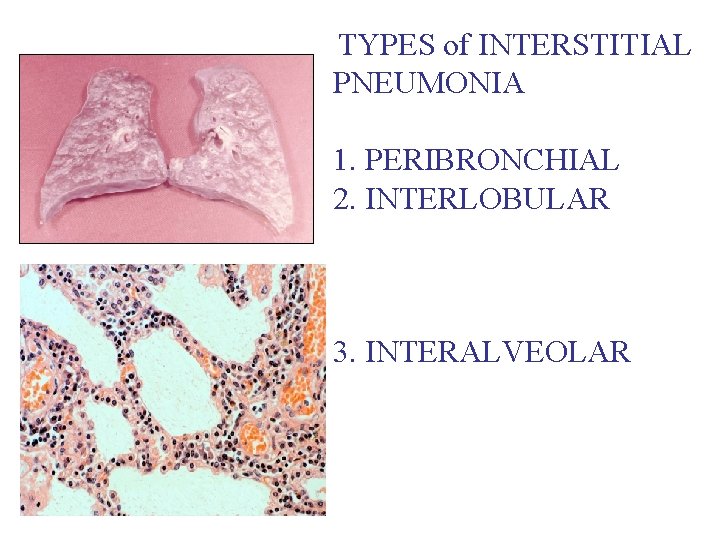 TYPES of INTERSTITIAL PNEUMONIA 1. PERIBRONCHIAL 2. INTERLOBULAR 3. INTERALVEOLAR 