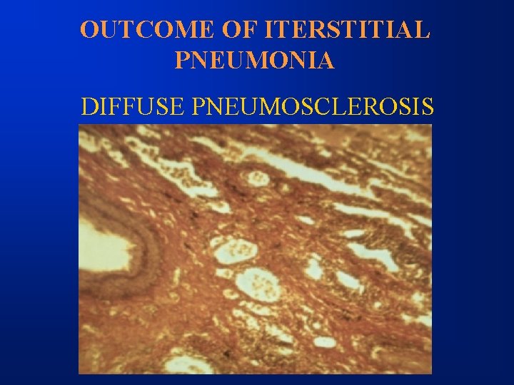 OUTCOME OF ITERSTITIAL PNEUMONIA DIFFUSE PNEUMOSCLEROSIS 