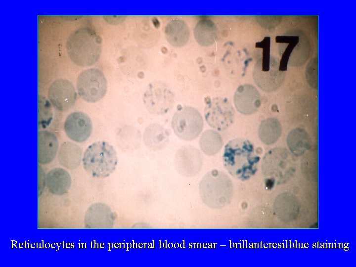 Reticulocytes in the peripheral blood smear – brillantcresilblue staining 