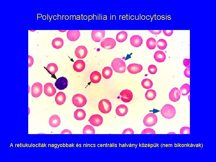 Polychromatophilia in reticulocytosis A retiukulociták nagyobbak és nincs centrális halvány középük (nem bikonkávak) 