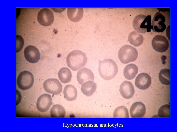 Hypochromasia, anulocytes 