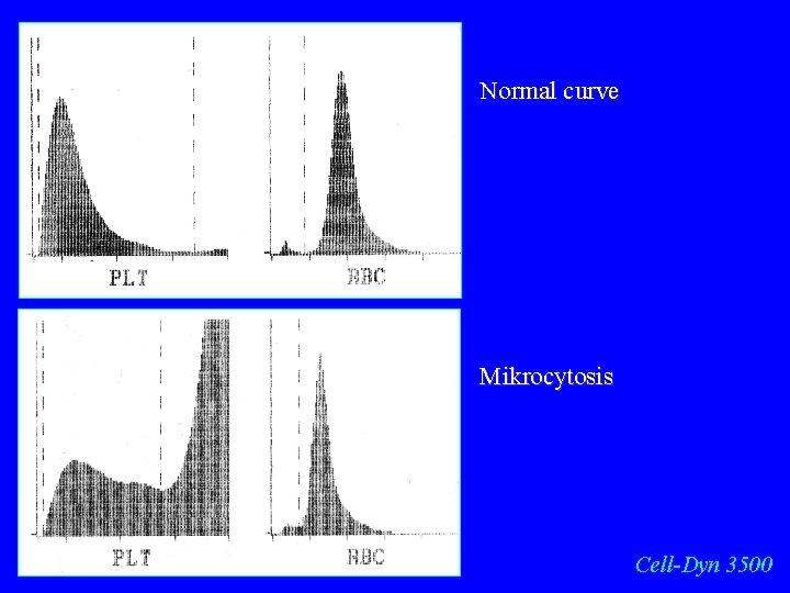 Normal curve Mikrocytosis Cell-Dyn 3500 