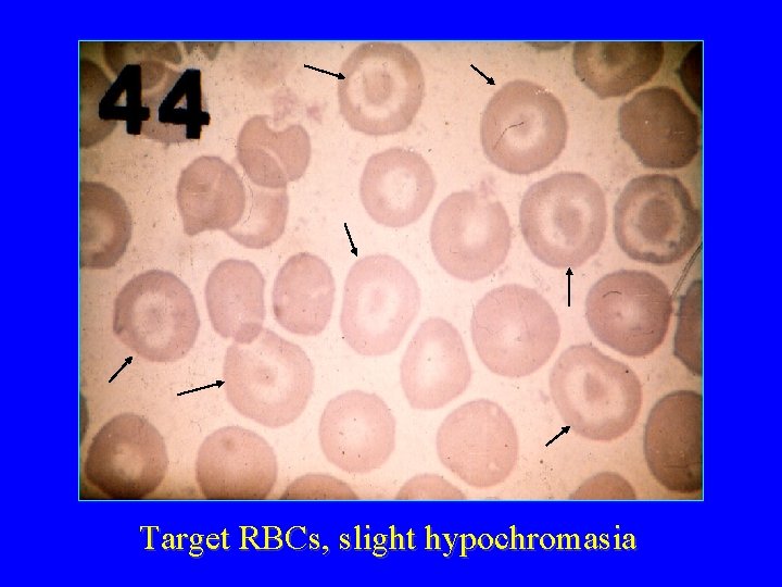Target RBCs, slight hypochromasia 