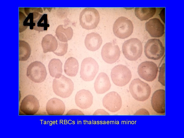 Target RBCs in thalassaemia minor 