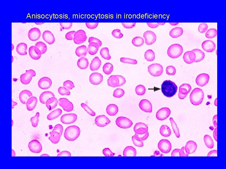 Anisocytosis, microcytosis in irondeficiency 