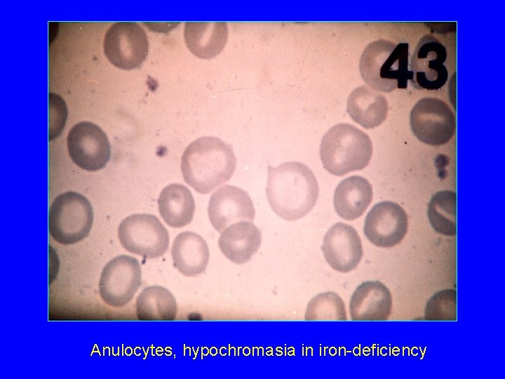 Anulocytes, hypochromasia in iron-deficiency 