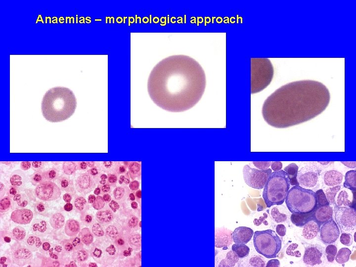 Anaemias – morphological approach 