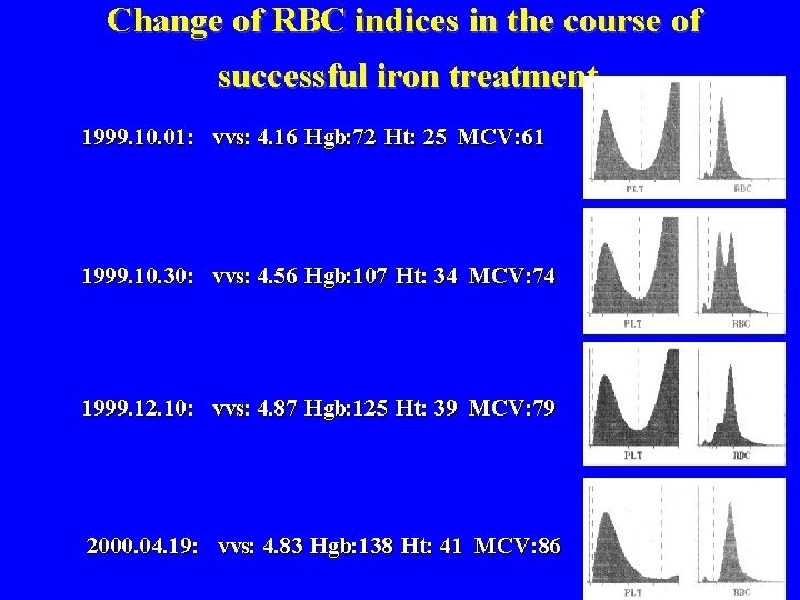 Change of RBC indices in the course of successful iron treatment 1999. 10. 01: