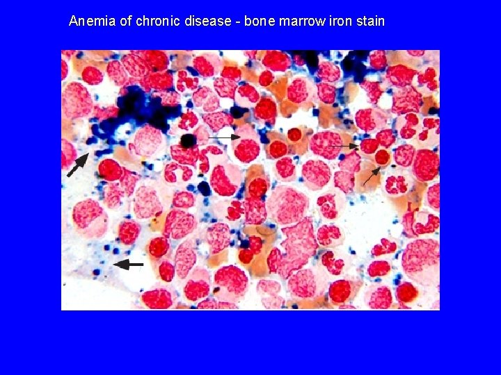 Anemia of chronic disease - bone marrow iron stain 