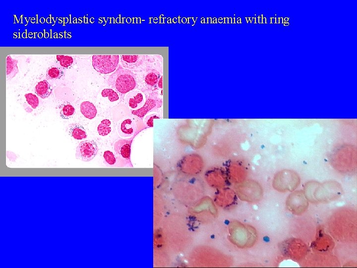 Myelodysplastic syndrom- refractory anaemia with ring sideroblasts 