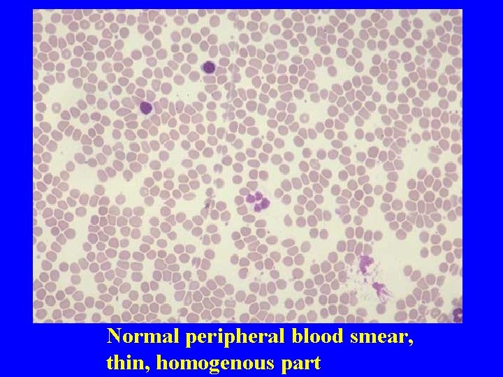 Normal peripheral blood smear, thin, homogenous part 