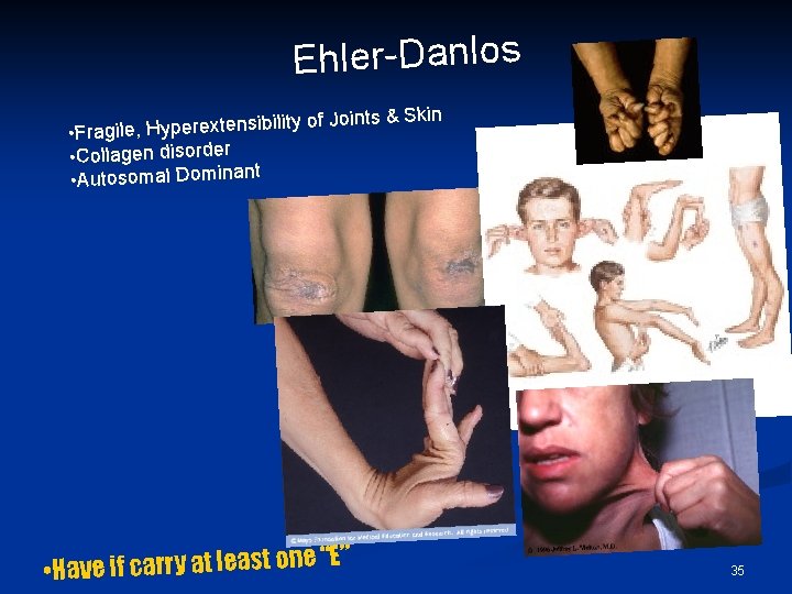 Ehler-Danlos kin of Joints & S ty ili b si n e xt re