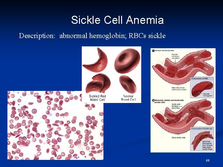 Sickle Cell Anemia Description: abnormal hemoglobin; RBCs sickle 44 