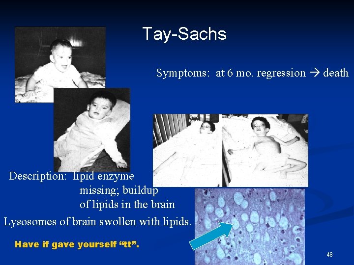 Tay-Sachs Symptoms: at 6 mo. regression death Description: lipid enzyme missing; buildup of lipids